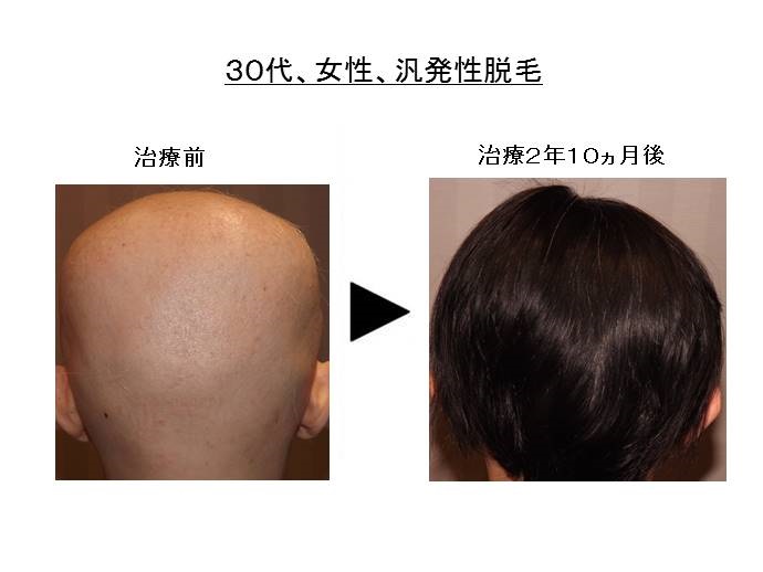 円形脱毛症　病院""